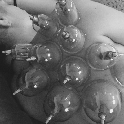 Cupping Therapy